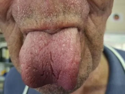 tongue 